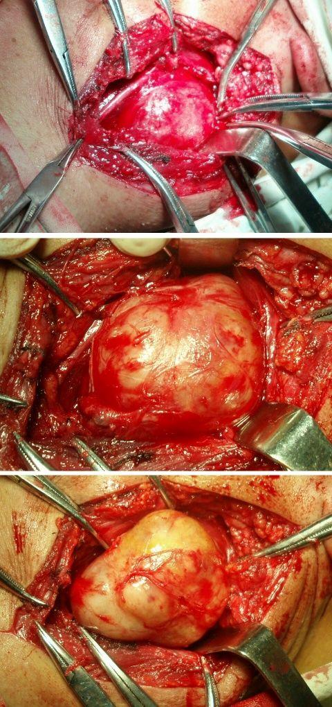 外毛根鞘瘤图片图片