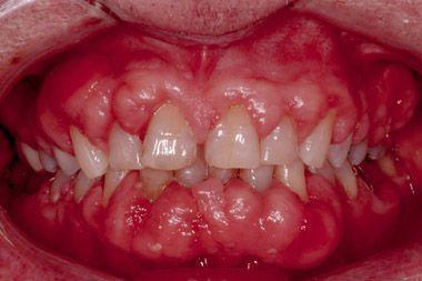 牙龈增生的症状图片图片