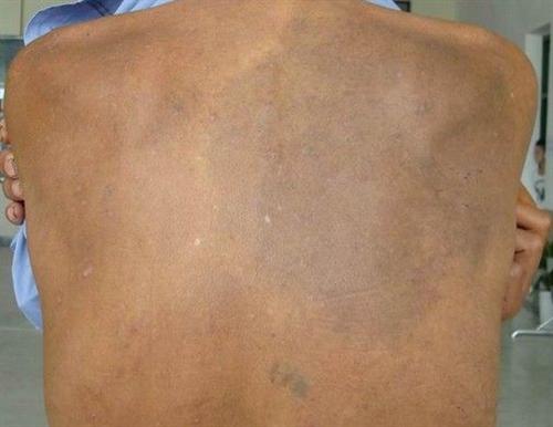 里尔黑变病的检查项目有哪些?