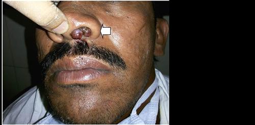 鼻腔恶性黑色素瘤