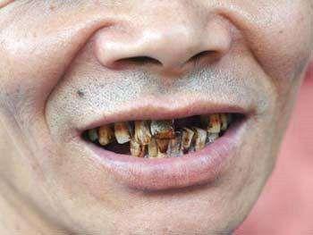 简介引起牙齿异常的原因